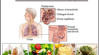 Natural Remedies for Emphysema Lung Disorder Manage with Vitamins and Diet